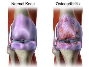 Knee and Joint Osteoarthritis: Building an Integrative Pain-Management Plan